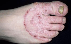 Důvody pro vzhled houby na nohou