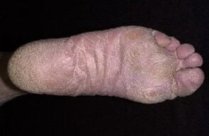 Příznaky a příznaky houby na nohou