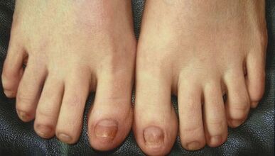 Fáze vývoje nehtových houby