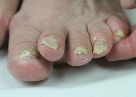 léčba plísně nehtů pomocí léků