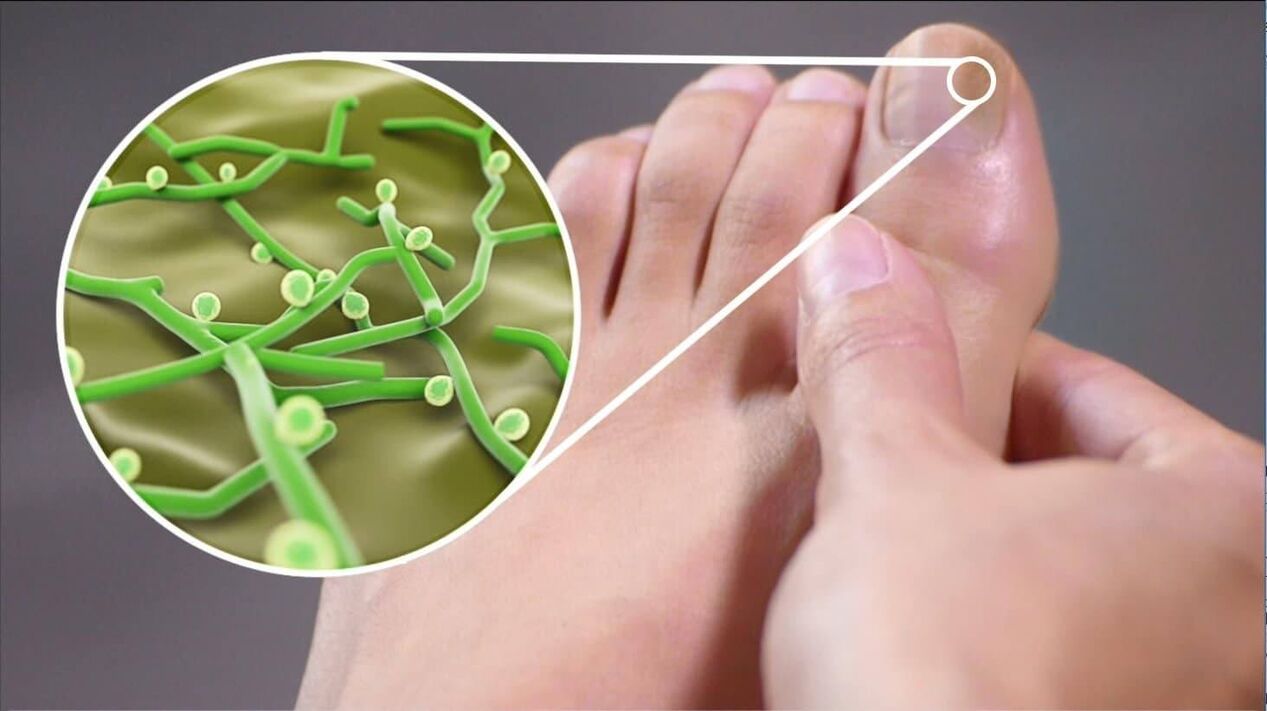 patogeny plísní nehtů na nohou