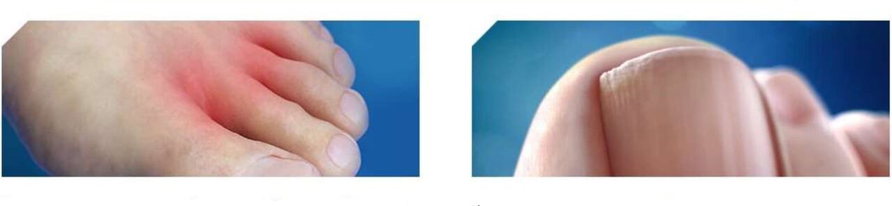 počáteční fáze plísně nohou